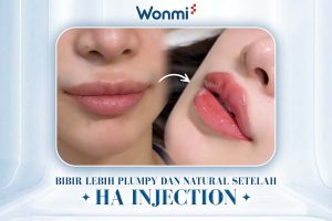 Bibir tampak lebih penuh dan natural setelah injeksi HA