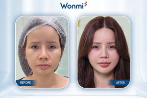 Gambar pelanggan setelah HA injection di Wonmi Clinic