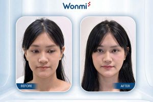 Injeksi HA tanpa downtime, hasil peremajaan terlihat seketika