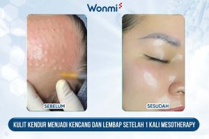 Kulit kendur menjadi lebih kencang dan lembap setelah 1 kali Mesotherapy.