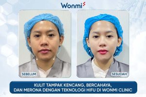 Kulit tampak kencang dan bercahaya dengan HIFU di Wonmi Clinic.