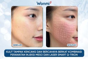 Kulit tampak lebih kencang dan bercahaya dengan kombinasi injeksi Meso dan Laser Smart Q-Trion.