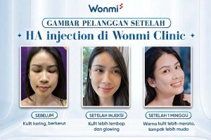 Mengapa banyak orang memilih HA injection dibanding metode kecantikan lainnya