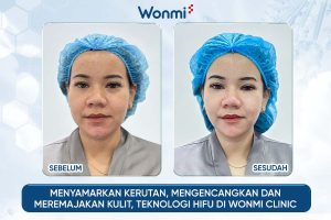 Menyamarkan kerutan dan mengencangkan kulit dengan teknologi HIFU di Wonmi Clinic.
